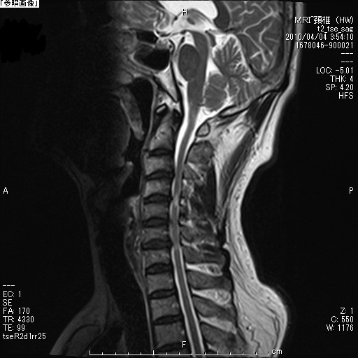 頚椎症術前MRI