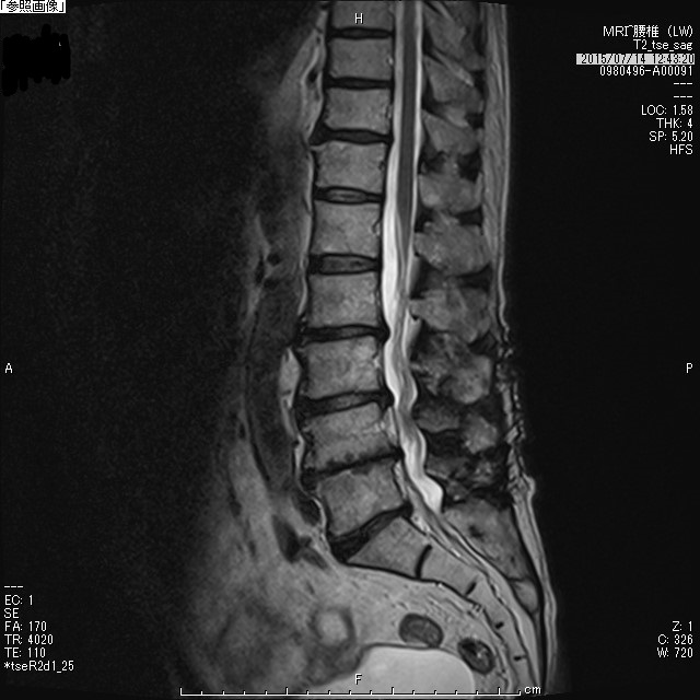 腰部脊柱管狭窄症術後MRI矢状断